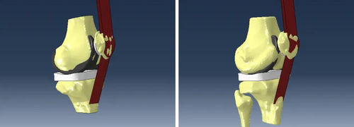 Software di analisi - Abaqus Knee Simulator - SIMULIA - di simulazione / di modellizzazione / di progettazione